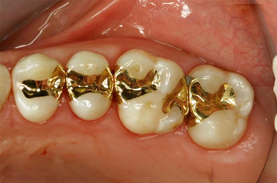 پر کردن دندان با طلا