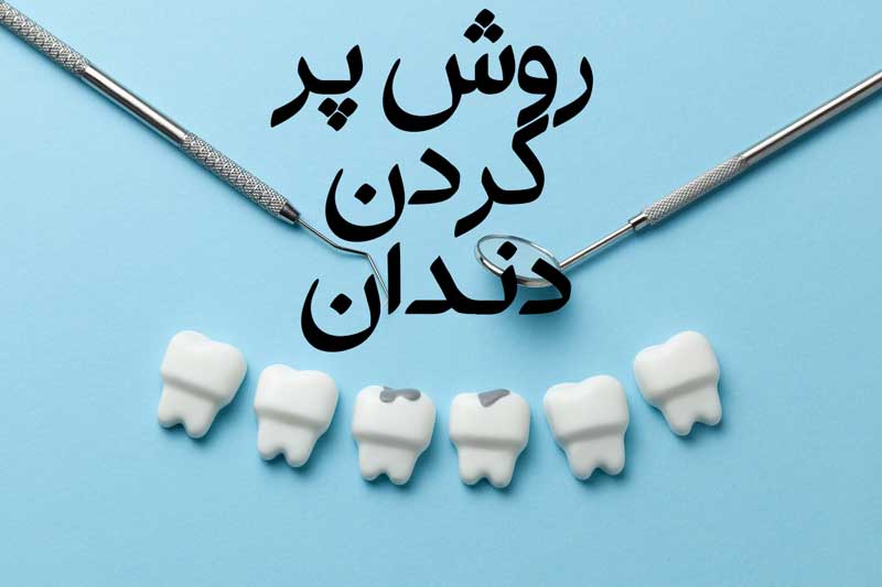 روش پر کردن دندان