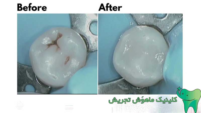 قبل و بعد پر کردن دندان
