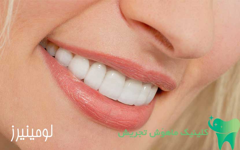 نمونه لومینیرز دندان در دهان