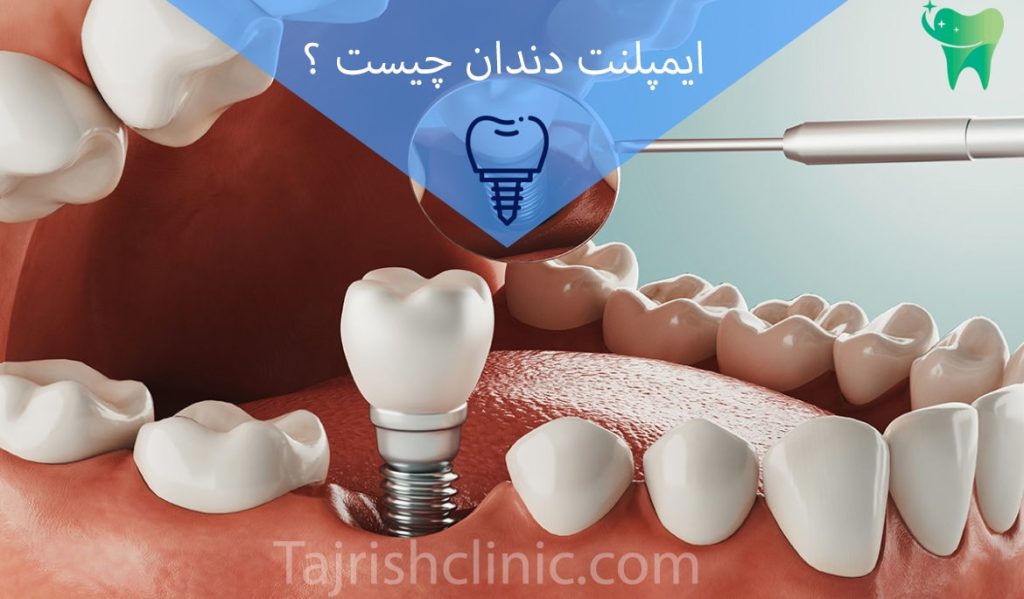 ایمپلنت دندان چیست 