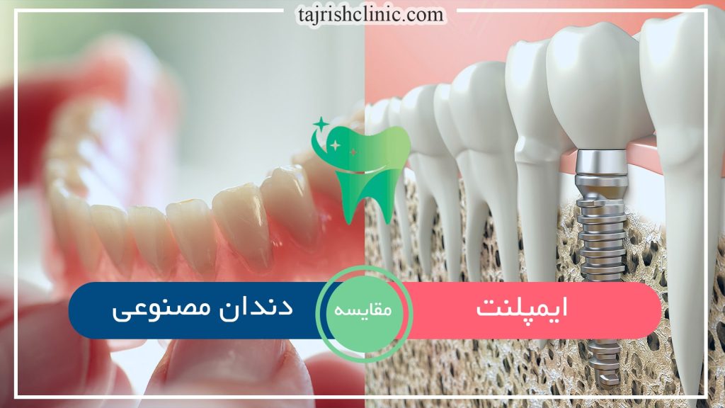 تفاوت ایمپلنت با دندان مصنوعی