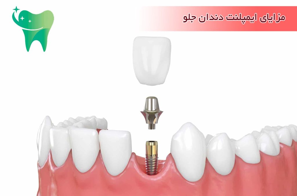مزایای ایمپلنت دندان جلو