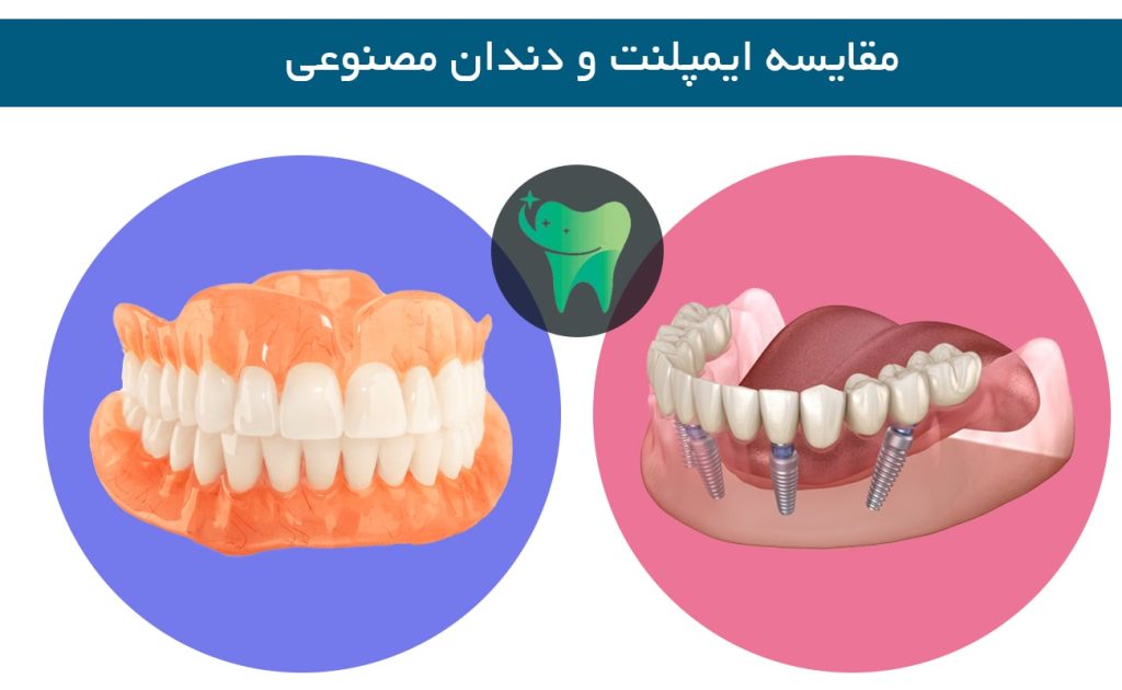 مقایسه ایمپلنت و دندان مصنوعی