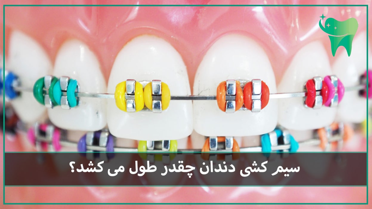سیم کشی دندان چقدر طول می کشد؟