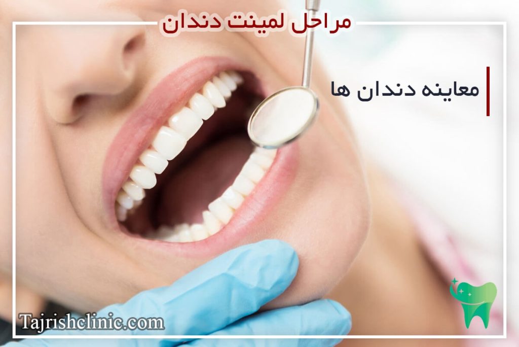 معاینه دندان در مراحل لمینت