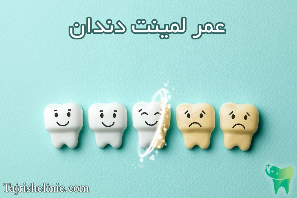 عمر لمینت دندان